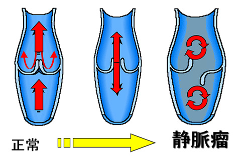 下肢静脈瘤とは