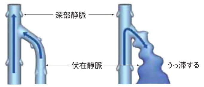 下肢静脈瘤とは